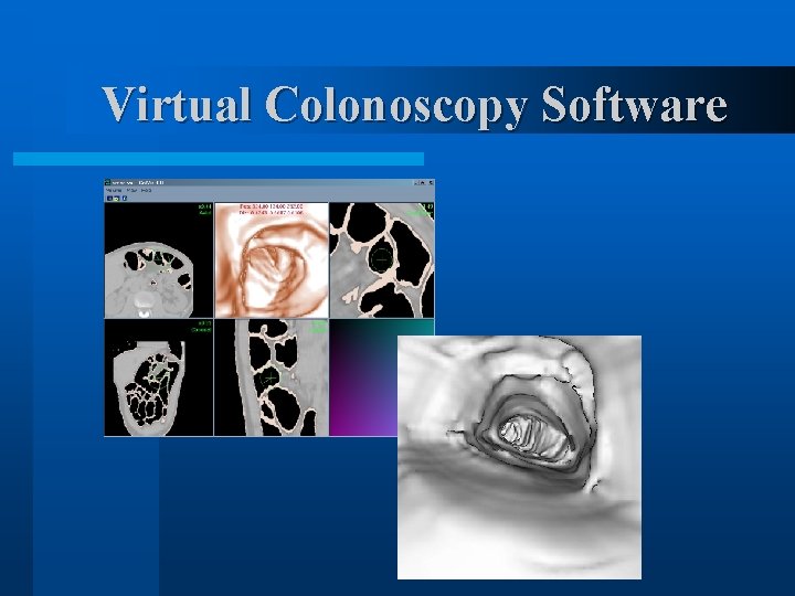 Virtual Colonoscopy Software 
