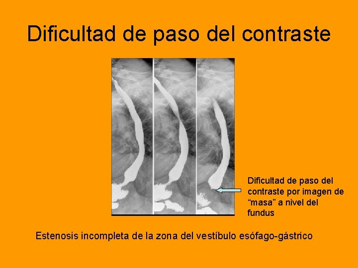 Dificultad de paso del contraste por imagen de “masa” a nivel del fundus Estenosis