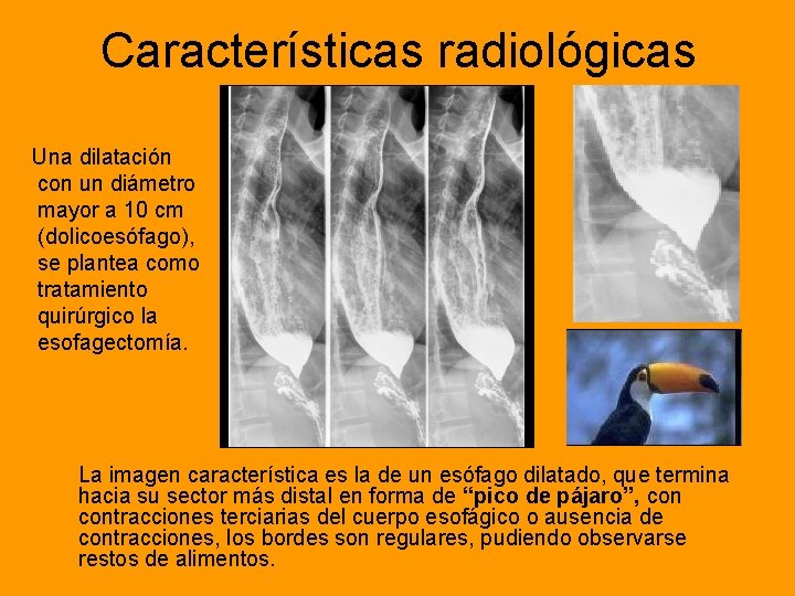 Características radiológicas Una dilatación con un diámetro mayor a 10 cm (dolicoesófago), se plantea