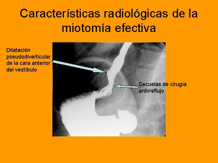 Características radiológicas de la miotomía efectiva Dilatación pseudodiverticular de la cara anterior del vestíbulo