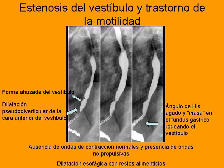 Estenosis del vestíbulo y trastorno de la motilidad Forma ahusada del vestíbulo Dilatación pseudodiverticular