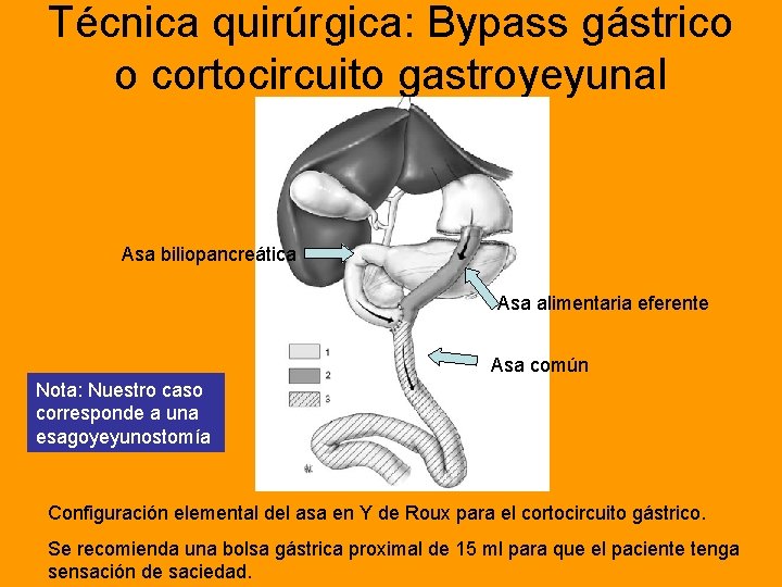 Técnica quirúrgica: Bypass gástrico o cortocircuito gastroyeyunal Asa biliopancreática Asa alimentaria eferente Asa común