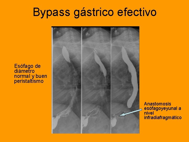 Bypass gástrico efectivo Esófago de diámetro normal y buen peristaltismo Anastomosis esófagoyeyunal a nivel