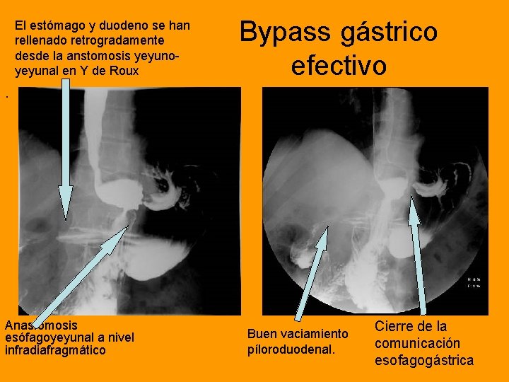 El estómago y duodeno se han rellenado retrogradamente desde la anstomosis yeyunoyeyunal en Y