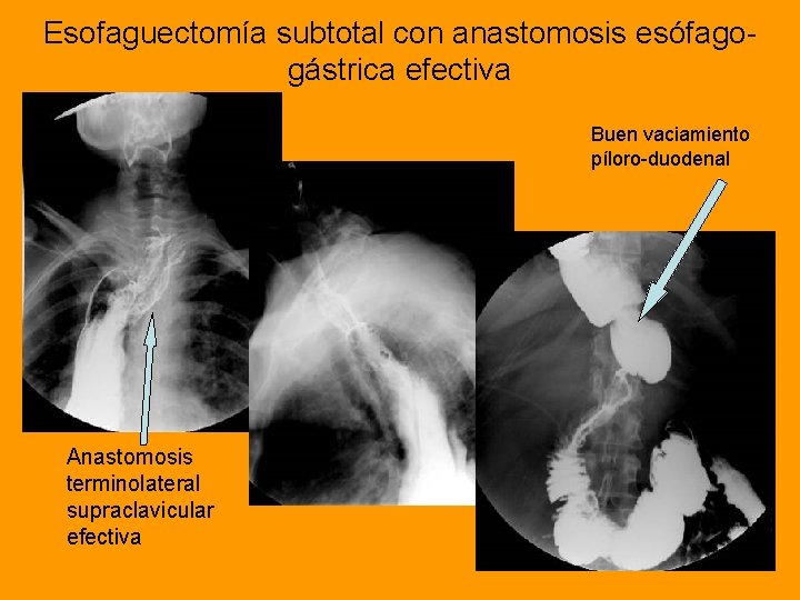 Esofaguectomía subtotal con anastomosis esófagogástrica efectiva Buen vaciamiento píloro-duodenal Anastomosis terminolateral supraclavicular efectiva 