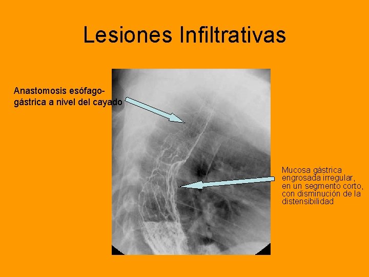 Lesiones Infiltrativas Anastomosis esófagogástrica a nivel del cayado Mucosa gástrica engrosada irregular, en un