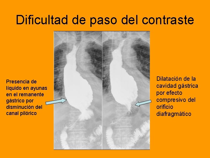 Dificultad de paso del contraste Presencia de líquido en ayunas en el remanente gástrico