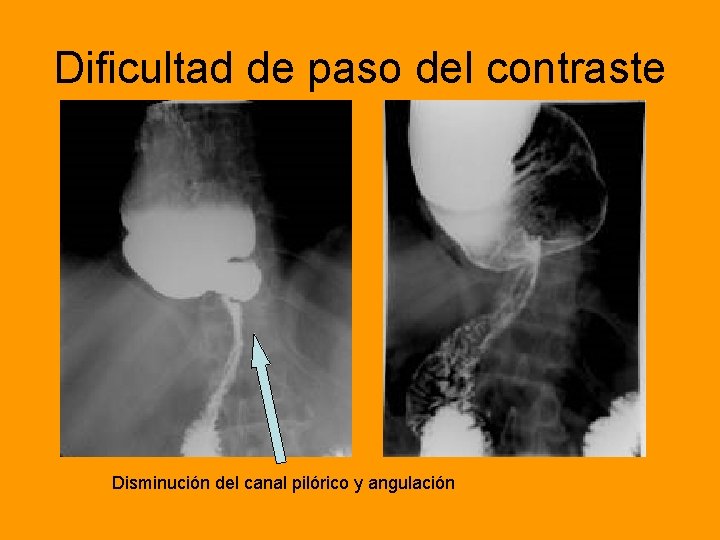 Dificultad de paso del contraste Disminución del canal pilórico y angulación 