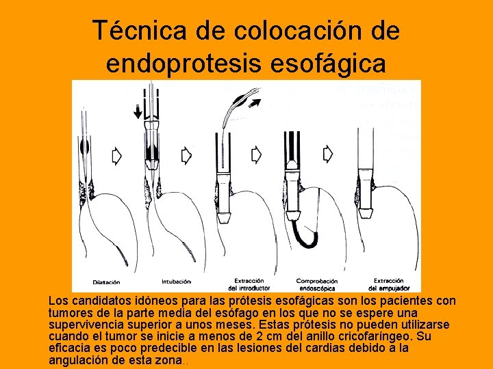 Técnica de colocación de endoprotesis esofágica Los candidatos idóneos para las prótesis esofágicas son