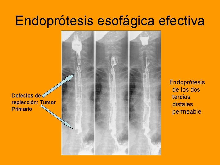 Endoprótesis esofágica efectiva Defectos de replección: Tumor Primario Endoprótesis de los dos tercios distales
