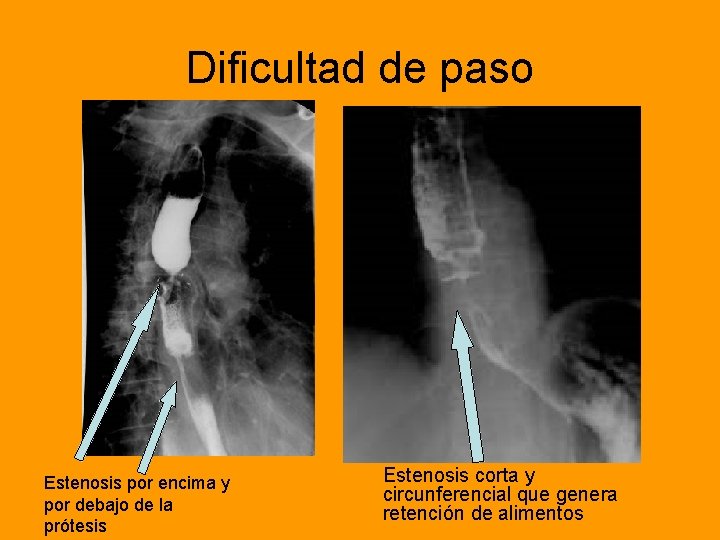 Dificultad de paso Estenosis por encima y por debajo de la prótesis Estenosis corta