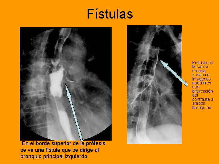 Fístulas Fístula con la carina en una zona con imágenes nodulares con bifurcación del