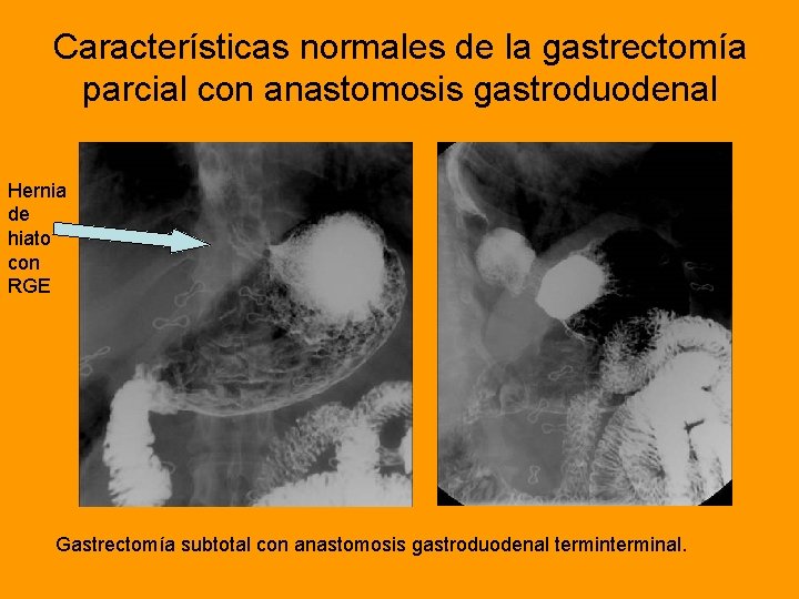 Características normales de la gastrectomía parcial con anastomosis gastroduodenal Hernia de hiato con RGE