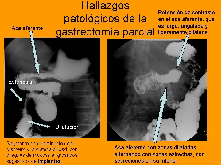 Asa eferente Hallazgos Retención de contraste el asa aferente, que patológicos de la en