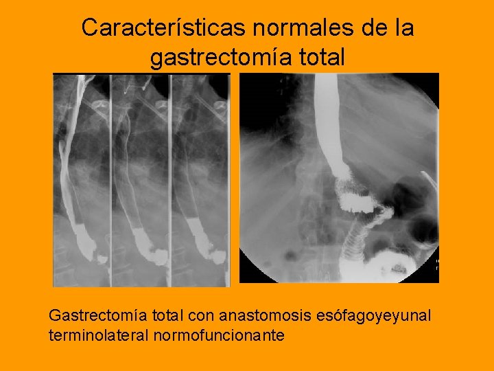 Características normales de la gastrectomía total Gastrectomía total con anastomosis esófagoyeyunal terminolateral normofuncionante 