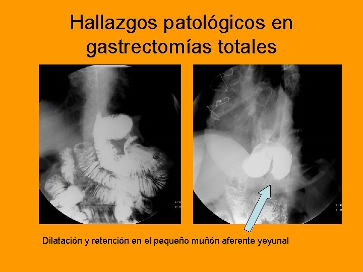 Hallazgos patológicos en gastrectomías totales Dilatación y retención en el pequeño muñón aferente yeyunal