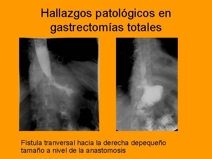 Hallazgos patológicos en gastrectomías totales Fístula tranversal hacia la derecha depequeño tamaño a nivel