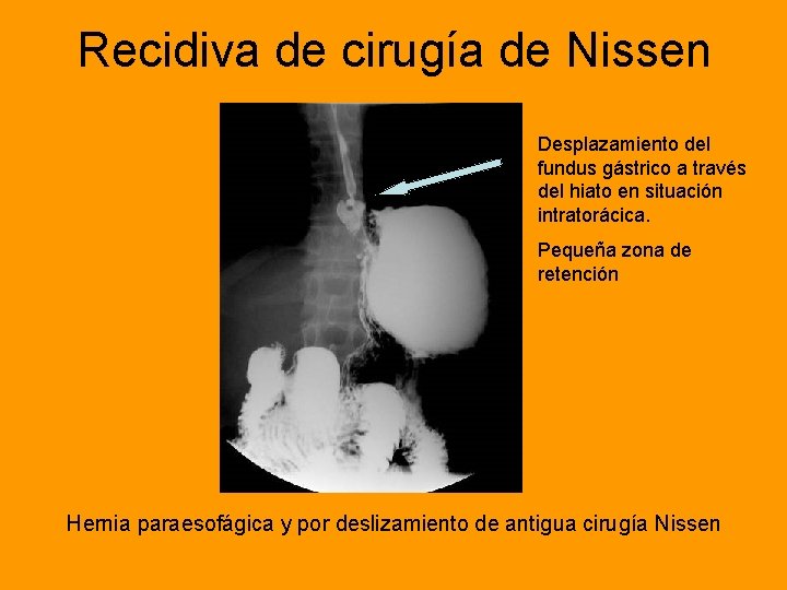 Recidiva de cirugía de Nissen Desplazamiento del fundus gástrico a través del hiato en