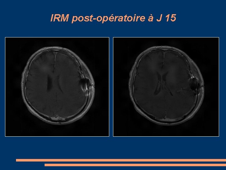 IRM post-opératoire à J 15 