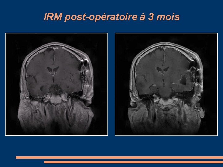 IRM post-opératoire à 3 mois 