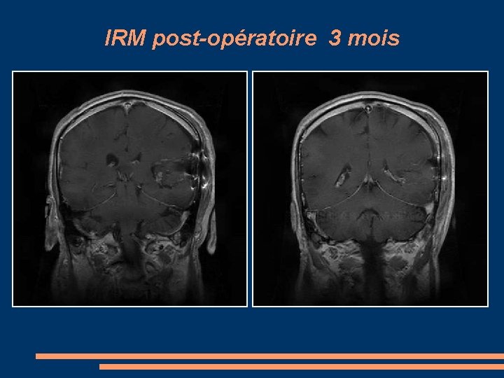 IRM post-opératoire 3 mois 