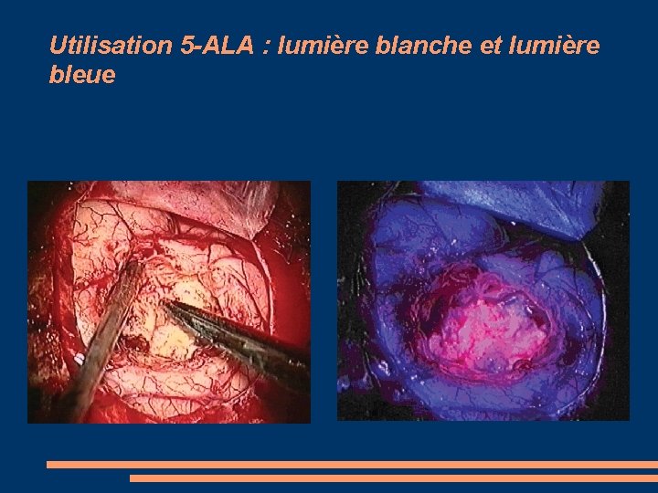 Utilisation 5 -ALA : lumière blanche et lumière bleue 