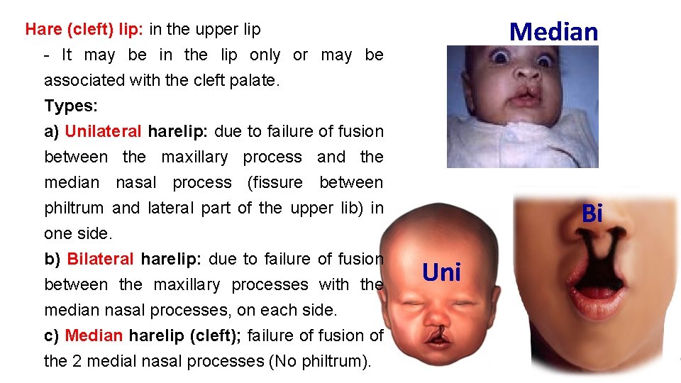 Hare (cleft) lip: in the upper lip - It may be in the lip