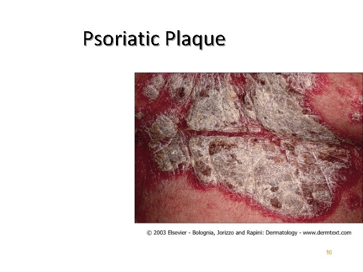 Psoriatic Plaque 16 