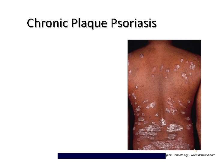 Chronic Plaque Psoriasis 19 