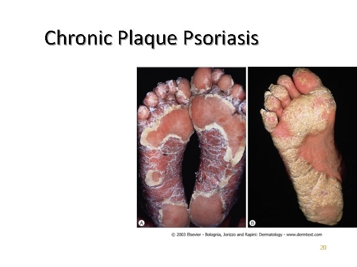 Chronic Plaque Psoriasis 20 