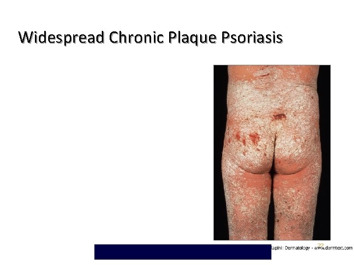 Widespread Chronic Plaque Psoriasis 22 