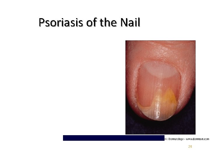 Psoriasis of the Nail 24 