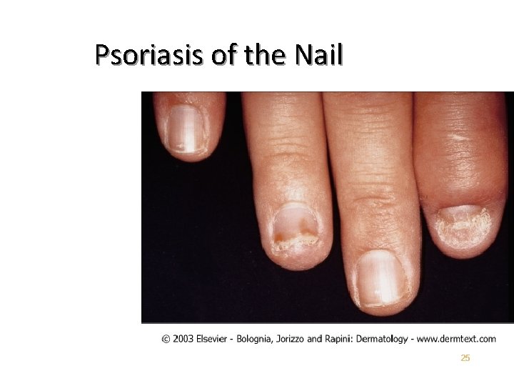 Psoriasis of the Nail 25 