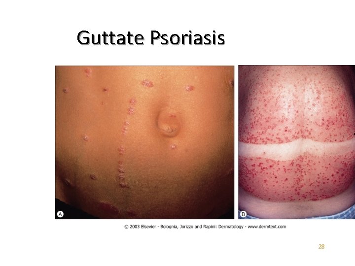 Guttate Psoriasis 28 