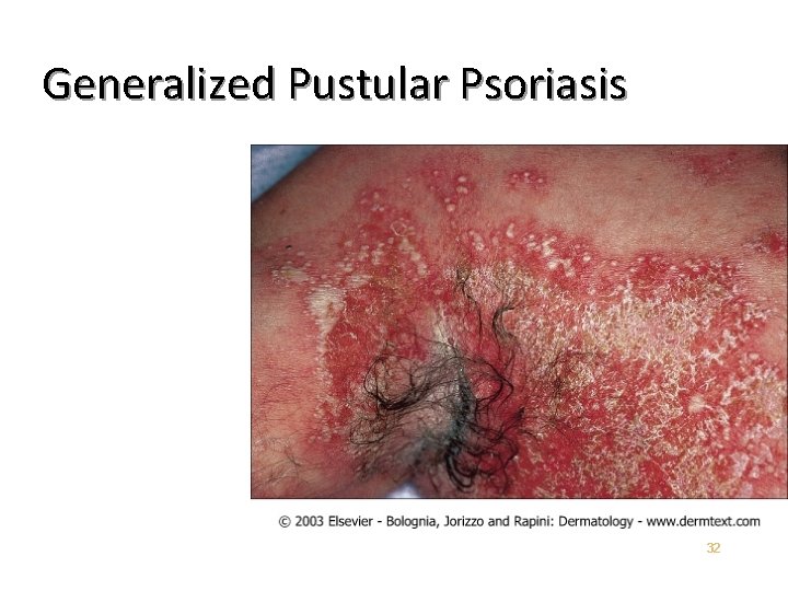 Generalized Pustular Psoriasis 32 