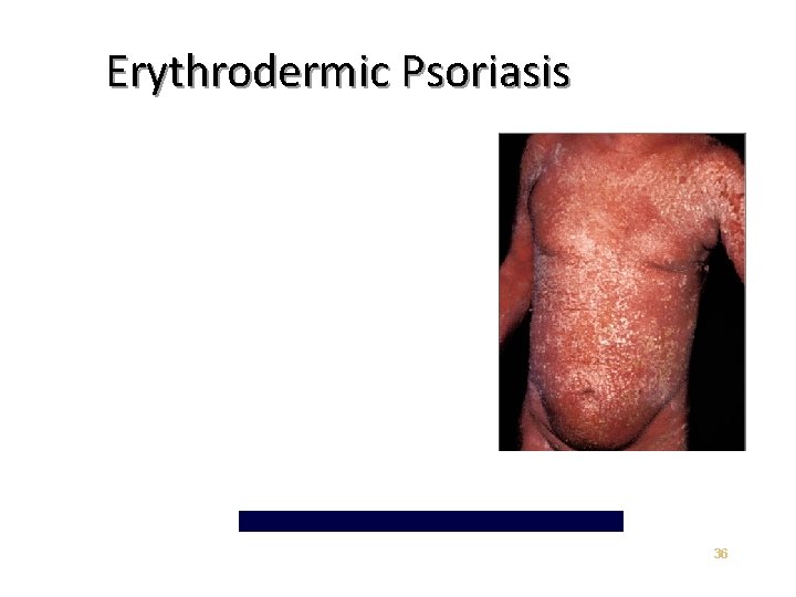 Erythrodermic Psoriasis 36 