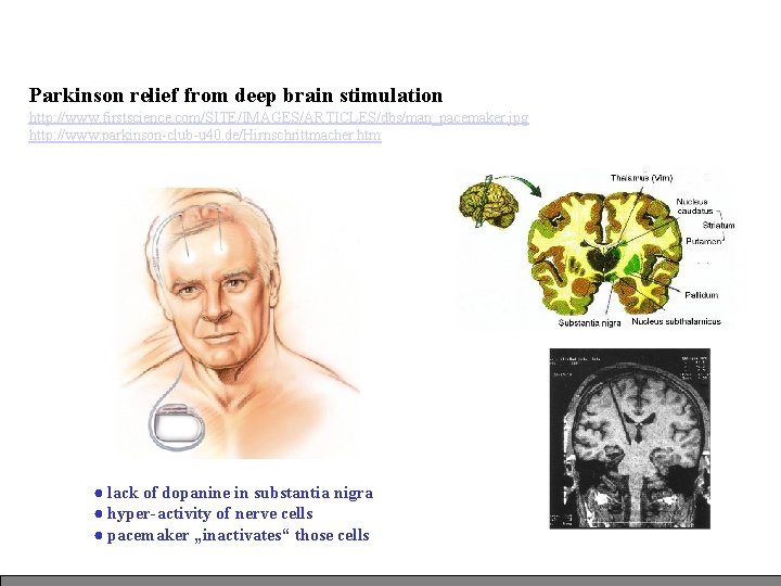 Parkinson relief from deep brain stimulation http: //www. firstscience. com/SITE/IMAGES/ARTICLES/dbs/man_pacemaker. jpg http: //www. parkinson-club-u