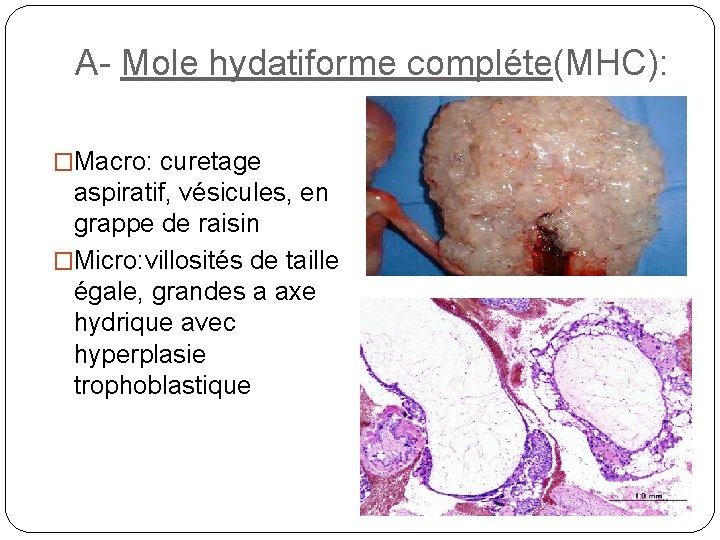 A- Mole hydatiforme compléte(MHC): �Macro: curetage aspiratif, vésicules, en grappe de raisin �Micro: villosités