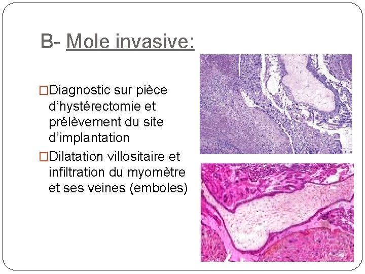 B- Mole invasive: �Diagnostic sur pièce d’hystérectomie et prélèvement du site d’implantation �Dilatation villositaire