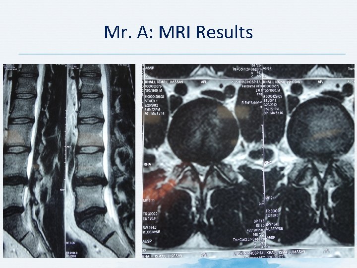 Mr. A: MRI Results 