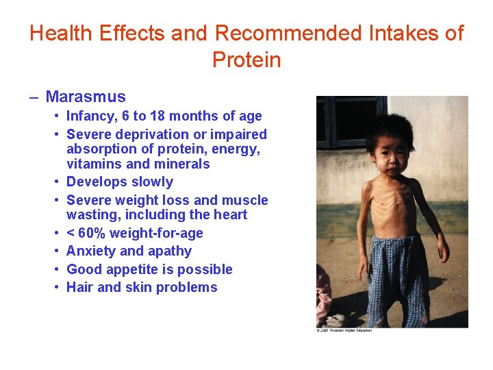 Health Effects and Recommended Intakes of Protein – Marasmus • Infancy, 6 to 18
