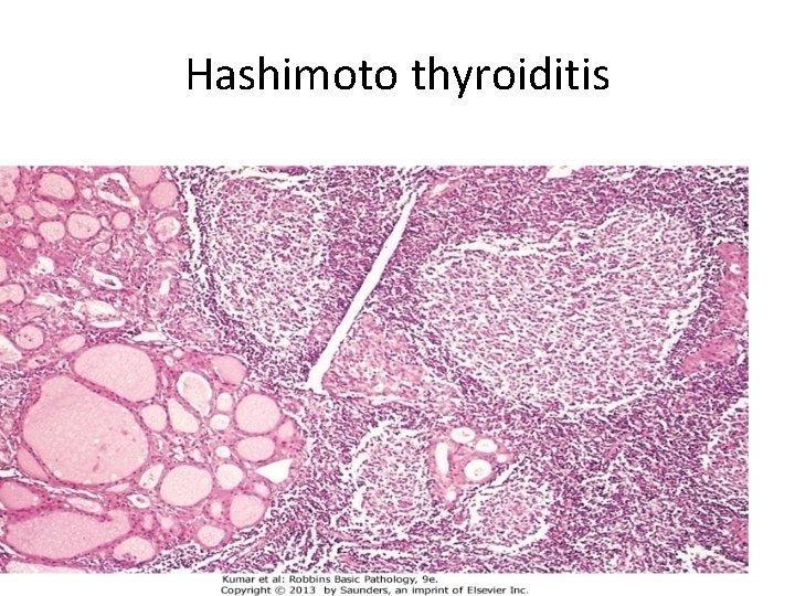 Hashimoto thyroiditis 