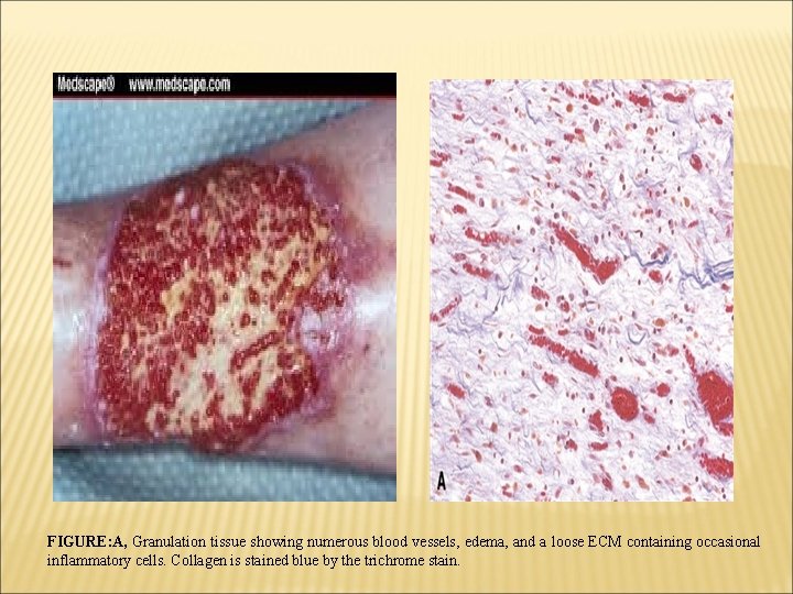FIGURE: A, Granulation tissue showing numerous blood vessels, edema, and a loose ECM containing