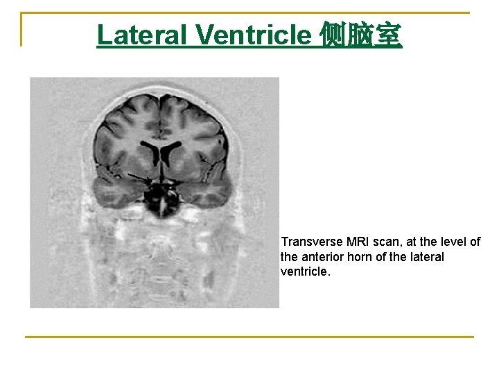 Lateral Ventricle 侧脑室 Transverse MRI scan, at the level of the anterior horn of