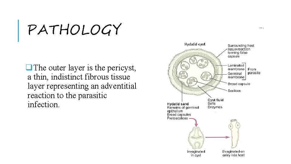 PATHOLOGY q. The outer layer is the pericyst, a thin, indistinct fibrous tissue layer