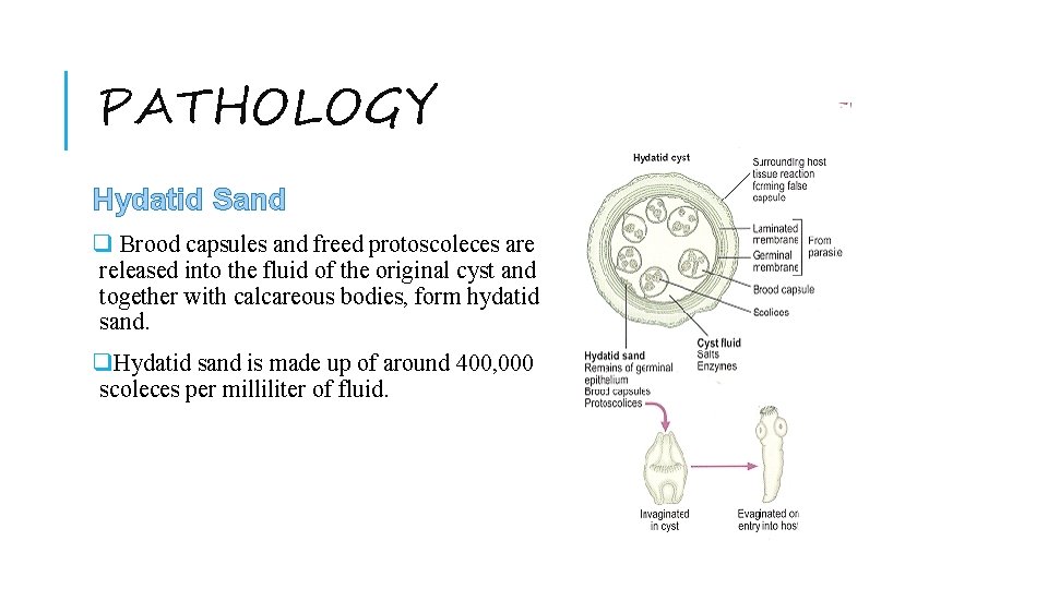 PATHOLOGY Hydatid Sand q Brood capsules and freed protoscoleces are released into the fluid