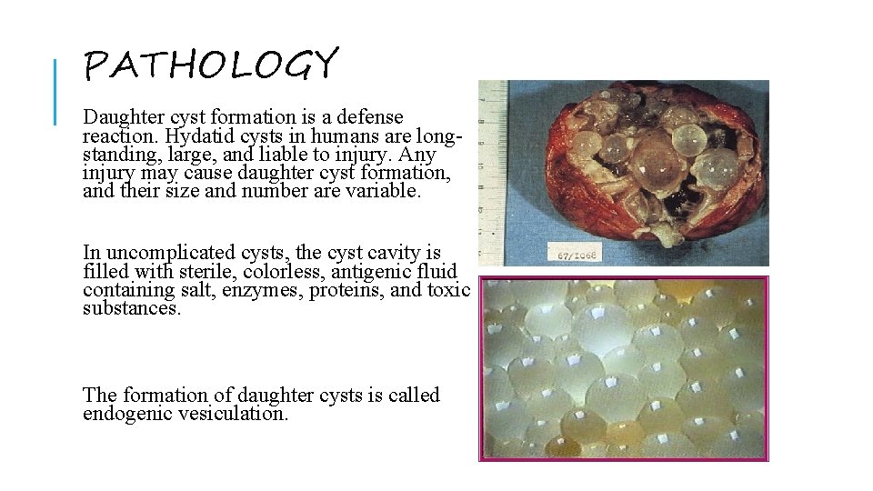 PATHOLOGY Daughter cyst formation is a defense reaction. Hydatid cysts in humans are longstanding,