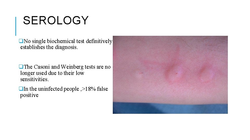 SEROLOGY q. No single biochemical test definitively establishes the diagnosis. q. The Casoni and