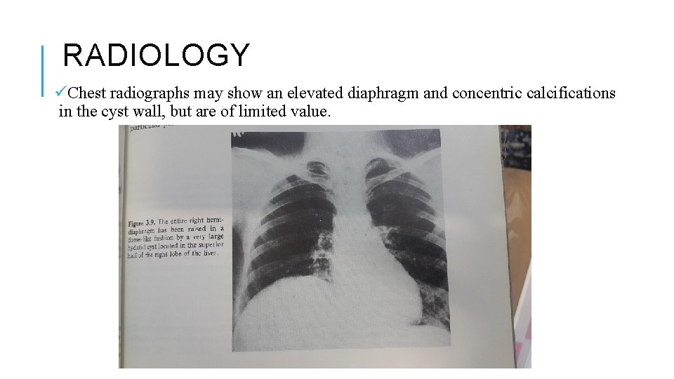 RADIOLOGY üChest radiographs may show an elevated diaphragm and concentric calcifications in the cyst