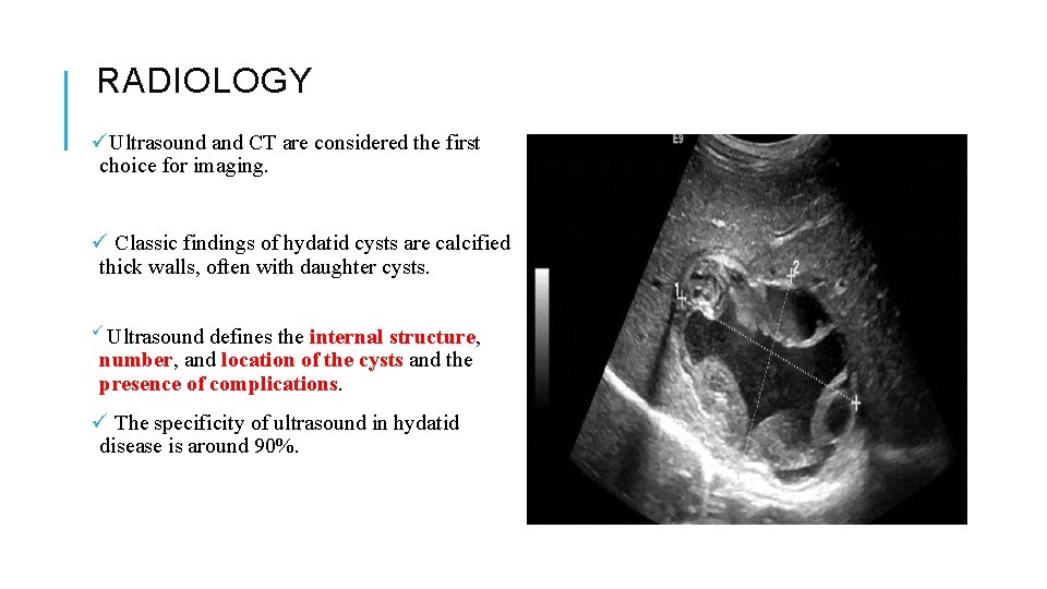RADIOLOGY üUltrasound and CT are considered the first choice for imaging. ü Classic findings